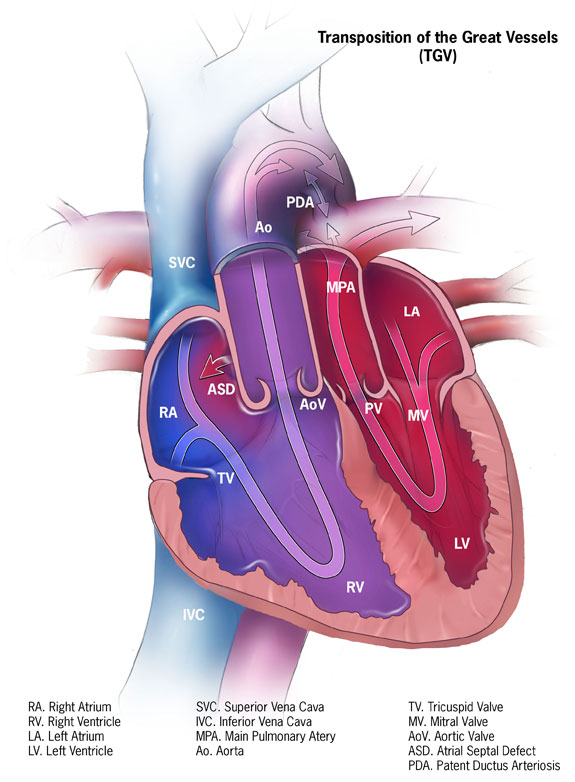 D-TGA heart image via CDC